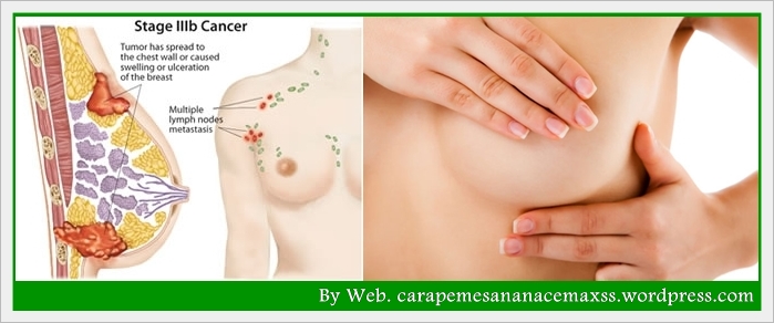 obat kanker payudara sedikit tentang kanker payudara kanker payudara ...